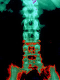 X-Ray Depicting Back Pain Spine and Pelvis X-Ray