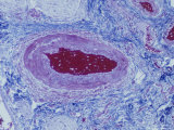 Normal Artery and Blood in Human Artery