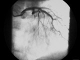 Cardiac Cath  Angiogram 99% Stenosis  Coronary Artery