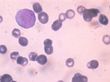 Acute Granulocytic Anemia Immature White Blood Cells