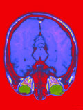 Brain Hemispheres Colorized MRI Normal