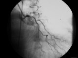 Cardiac Cath  90% Stenosis Main Coronary Artery