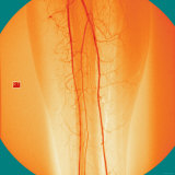 Venogram of the Leg Blood Vessels Capillaries X-Ray