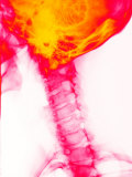 Neck Cervical Spine X-Ray Enhanced Skull Head
