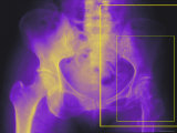 Xray Colorized Female Hip Pelvis Osteoporosis