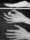 X-Ray Normal Hand Wrist Pinch Dorsal Lateral View