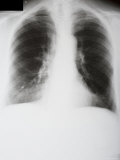 Chest X-Ray Post Operative Mastectomy