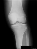 X-Ray Normal Knee Frontal View Adolescent