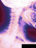 Colorized X-Ray Showing Normal Cervical Spine Lateral View Vertebrae C1-C7