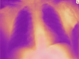 Xray Colorized Chest Normal Lungs