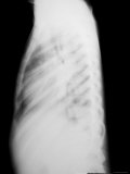Chest X-Ray Pediatric Lateral View of Chest