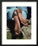 Close up of a pilgrims feet after walking the Stations of the Cross on Lough Derg