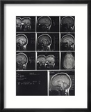 X-Ray Photographs of Person's Skull