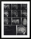 X-Ray Photographs of Person's Skull