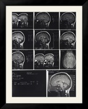 X-Ray Photographs of Person's Skull