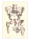 Sacroiliac Bones