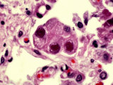 Cytomegalovirus with a Large Inclusion in the Nucleus of Lung Cells