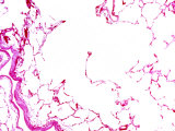 Emphysema of the Lungs  Showing Many Alveoli That Have Enlarged and Burst