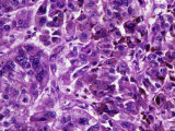 Skin Section from a Patient with Malignant Melanoma