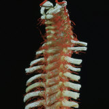 Human Cadaver Dissection Showing the Arteries of the Vertebral Column