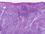 Human Skin Section of a Patient with Malignant Melanoma