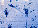 Penicillium Fungus Culture from a Human Patient  Lactophenol Ccotton Blue Preparation