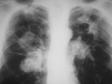 X-Ray of Tuberculosis Calcification Caused by Mycobacterium Tuberculosis Bacteria