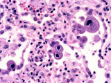 Cytomegalovirus  Cmv  Pneumonitis in the Lung  H&E Stain