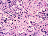 Cytomegalovirus  Cmv  Pneumonitis in the Lung  H&E Stain