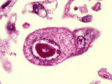 Cytomegalovirus with a Large Inclusion from the Lung of a Human Immunocompromised Patient