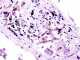 Lung Tissue with Asbestos Bodies  Interstitial Fibrosis  H&E Stain