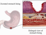 Biomedical Illustration Showing an Acute Gastric (Peptic) Ulcer