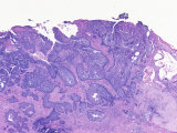 Human Skin Section of a Patient with Basal Cell Carcinoma