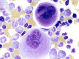 Human Bone Marrow with Two Megakaryocytes