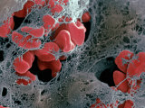 Blood Clot Formation  Showing Trapped Red Blood Cells or Erythrocytes in Fibrin