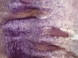 Longitudinal-Section of a Wart on the Back of the Human Hand