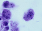 Phagocytes in the Human Lung Showing Ingested Carbon Granules in their Cytoplasm
