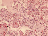 Human Lung Tissue from a Patient with Bronchial Pneumonia