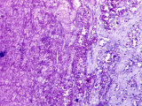 Thrombosis of the Human Iliac Artery
