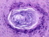 Solar Keratosis of Human Skin