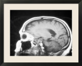 Brain Tumor in MRI Cancer Medical Imaging