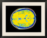 Human Brain Normal CT Scan