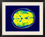 Normal MRI Head Transverse Magnetic Resonance Image