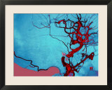 Blocked Vein Brain Burst Aneurysm Cerebral Blood
