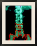 X-Ray Depicting Back Pain Spine and Pelvis X-Ray