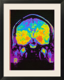 Magnetic Resonance Imaging MRI of Head