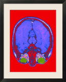 Brain Hemispheres Colorized MRI Normal