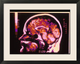 Magnetic Resonance Imaging Lateral View of Head
