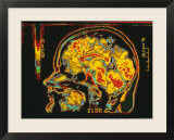 Magnetic Resonance Imaging Lateral View of Head