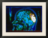 Magnetic Resonance Imaging Lateral View of Head